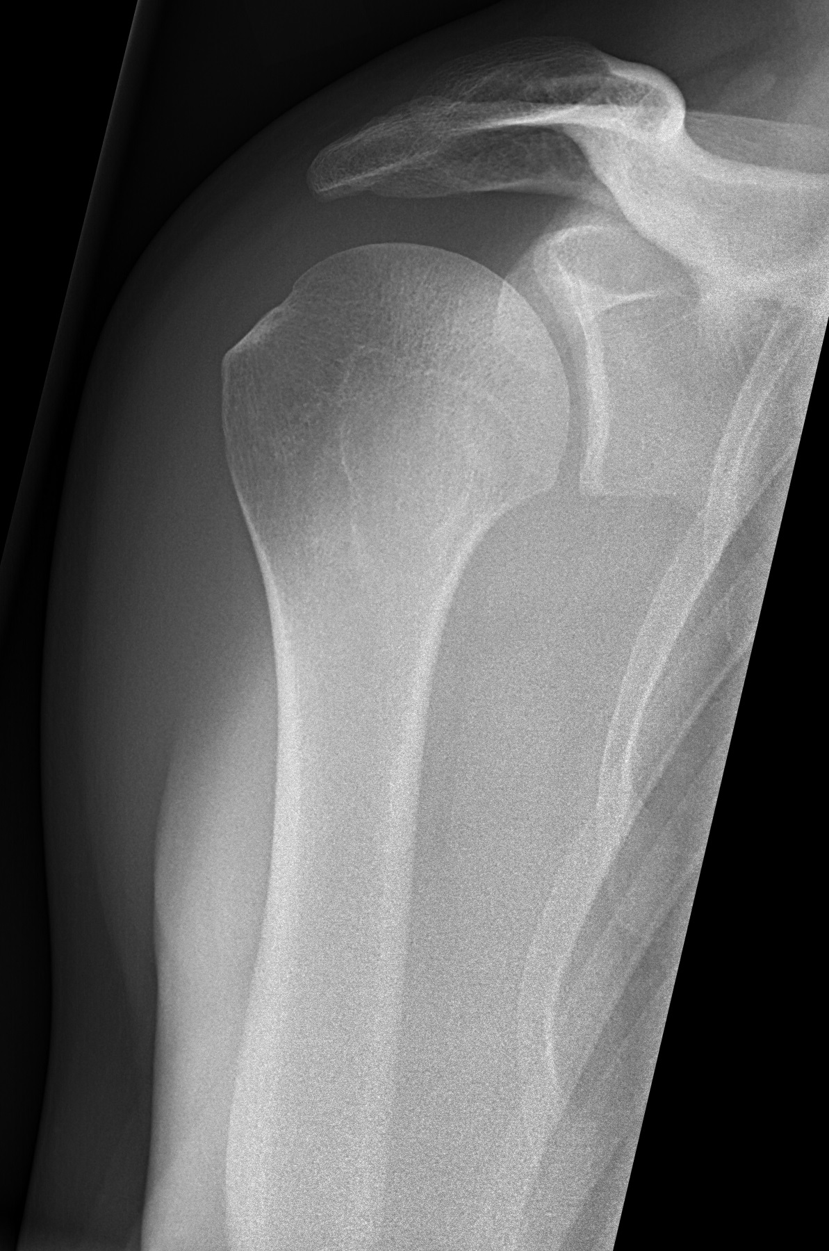 Radiografia de ombro normal na incidência de Grashey, sem rótulos. A cabeça do úmero está centrada na cavidade glenoidal, com o espaço articular aberto em perfil. Acima dela, o acrômio se projeta lateralmente como um teto ósseo, separado da cabeça umeral e do tubérculo maior por um espaço claro. Veem-se ainda a clavícula, a articulação acromioclavicular, o processo coracoide e o colo cirúrgico do úmero, logo abaixo dos tubérculos.