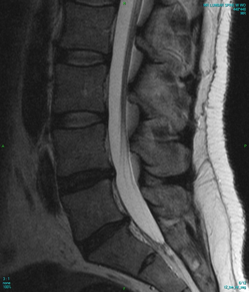 Ressonância magnética da coluna lombar, corte sagital mediano ponderado em T2. Vêem-se os corpos vertebrais lombares empilhados, os discos intervertebrais entre eles, e uma faixa vertical de sinal muito claro percorrendo o canal vertebral, correspondente ao líquido cerebrospinal dentro do saco dural. Abaixo, o sacro.