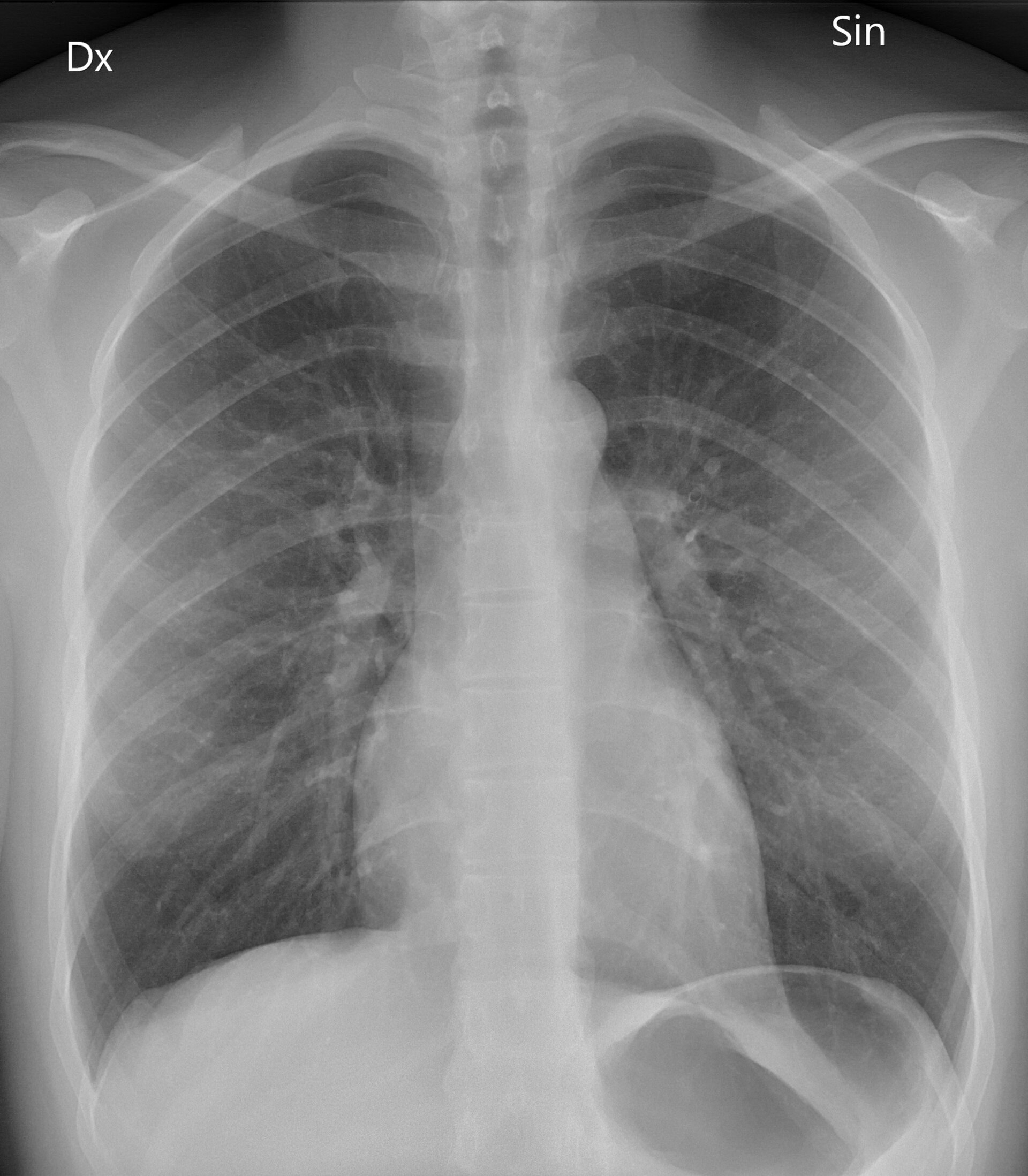 Radiografia de tórax normal em incidência posteroanterior, com os dois campos pulmonares, a silhueta cardíaca e as cúpulas diafragmáticas.