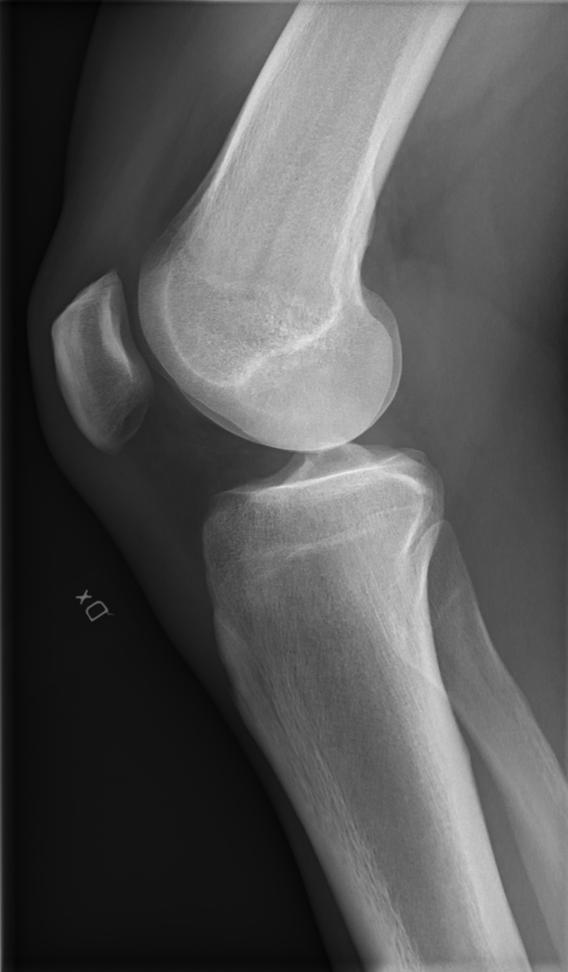 Radiografia de um joelho normal em perfil, com a extremidade do fêmur em cima, a da tíbia embaixo, a patela à frente e uma faixa escura entre fêmur e tíbia.