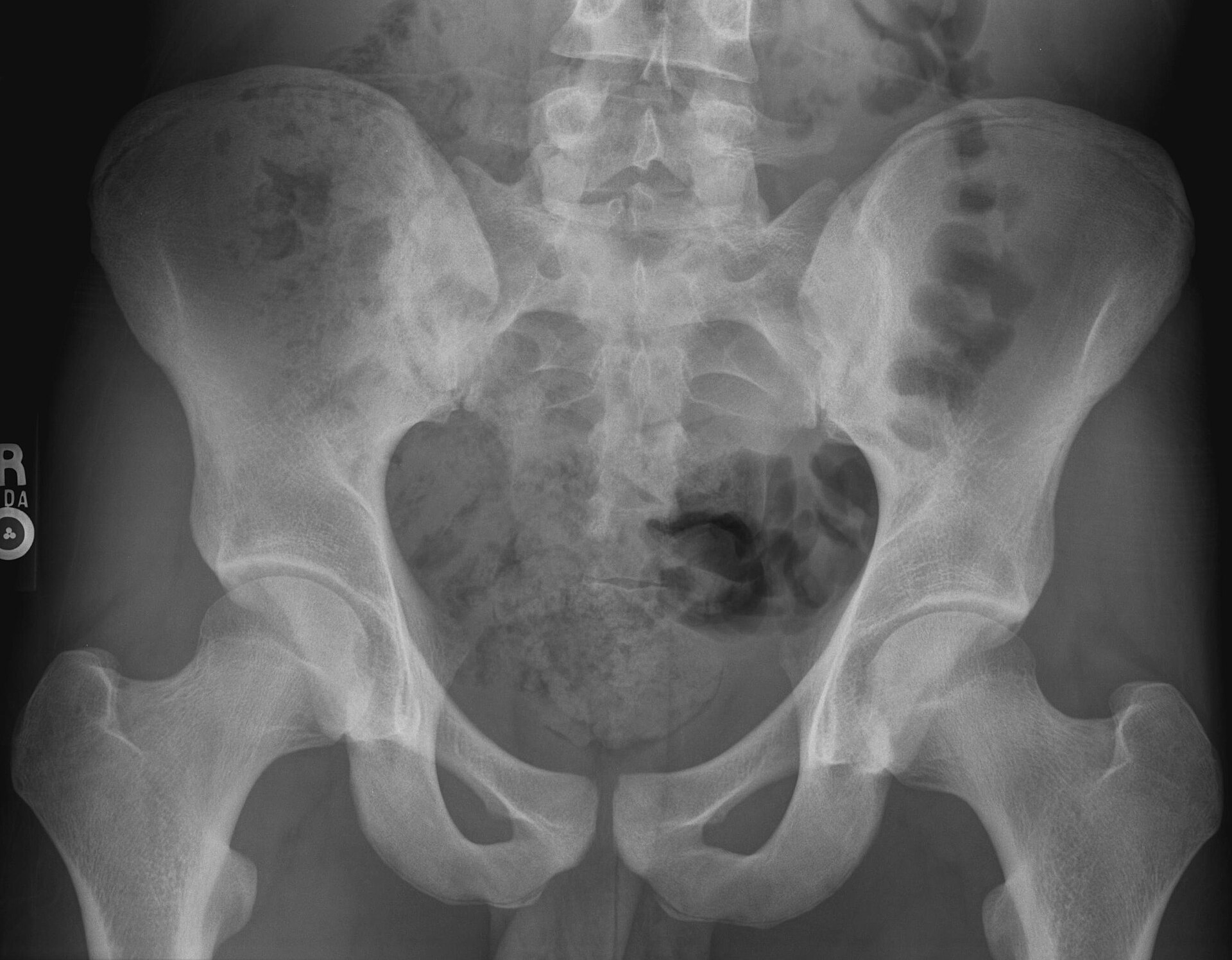Radiografia de frente da bacia de um adulto, com as duas asas do ilíaco, o sacro entre elas, os forames obturados, a sínfise púbica e a extremidade superior dos dois fêmures.
